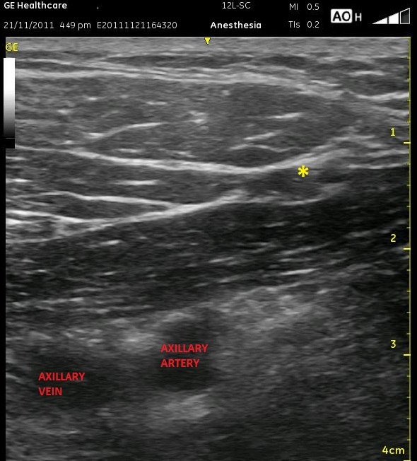 Infraclavicular labeled axillary vein