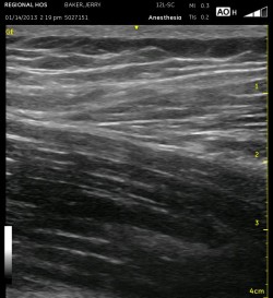 iliopsoas muscle w sartorius muscle above