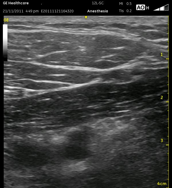 Infraclav decompressed with axillary vein