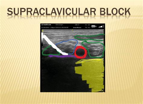 _wsb_475x346_Supraclavicular+sonoanatomy