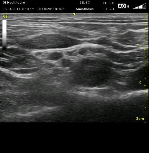 _wsb_505x520_supraclavicular+image