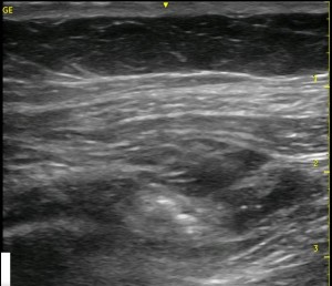 TAP Block post-injection