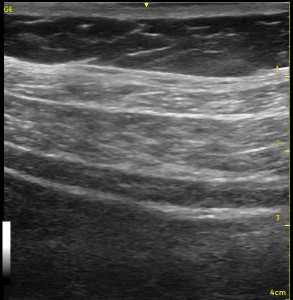 TAP Sonoanatomy